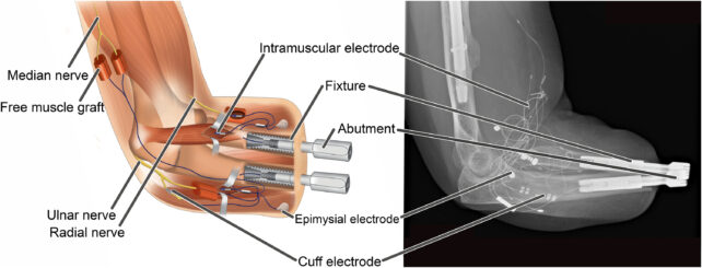 Bionisk hand smälter samman med kvinnas ben, muskler och nerver

